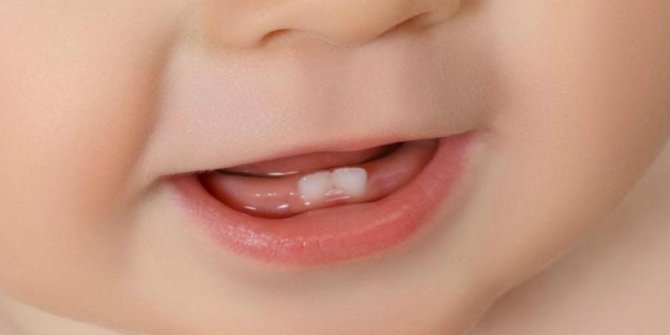 Süt dişlerinin çürüyüp erken çekilmesi halinde ne yapılması gerekir?