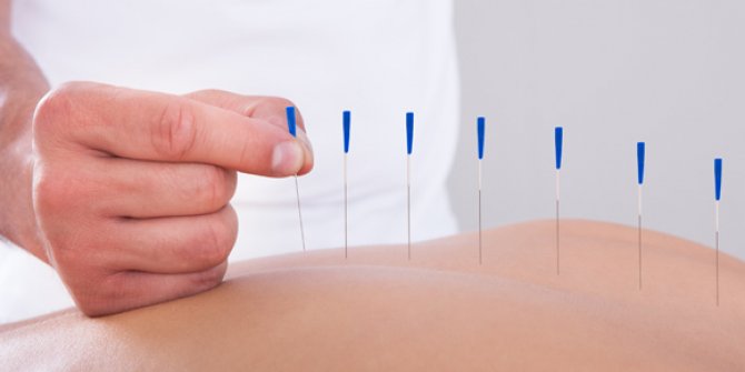 Akupunktur nedir? Akupunktur ile zayıflama